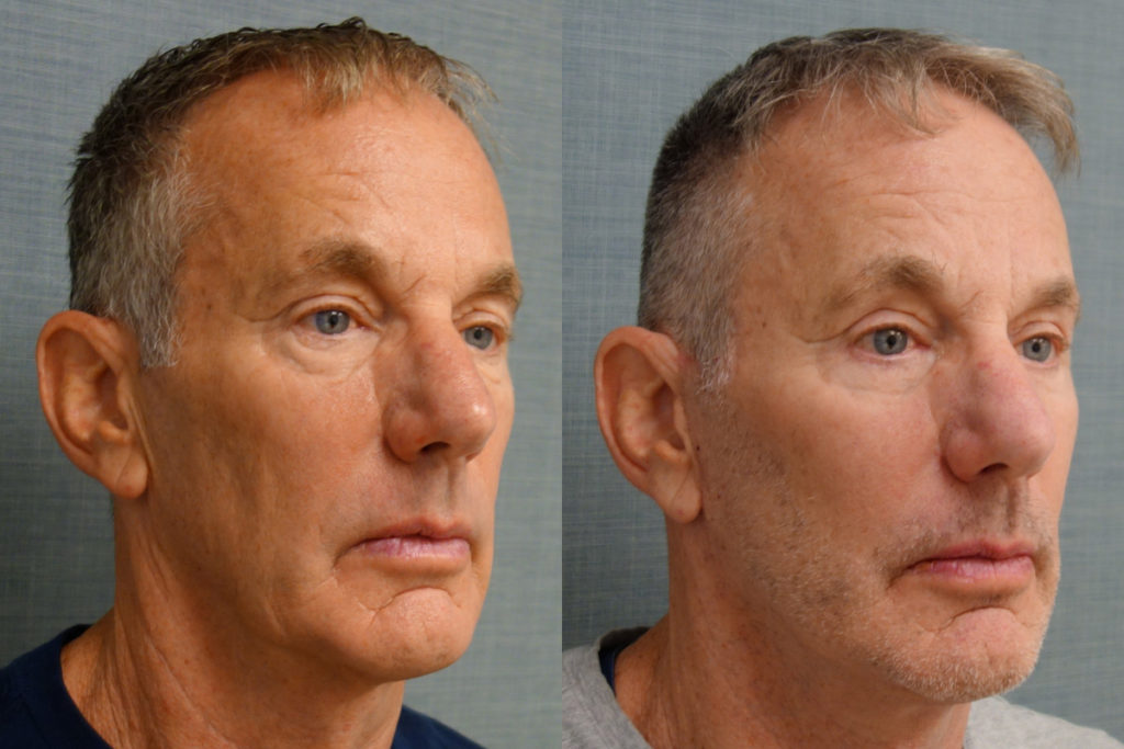 Bilateral Upper Eyelid Blepharoplasty, Bilateral Lower Eyelid Blepharoplasty, Bilateral Upper Eyelid Internal Ptosis Repair Patient 21-B Bilateral Upper Eyelid Blepharoplasty, Bilateral Lower Eyelid Blepharoplasty, Bilateral Upper Eyelid Internal Ptosis Repair Patient 21-B
