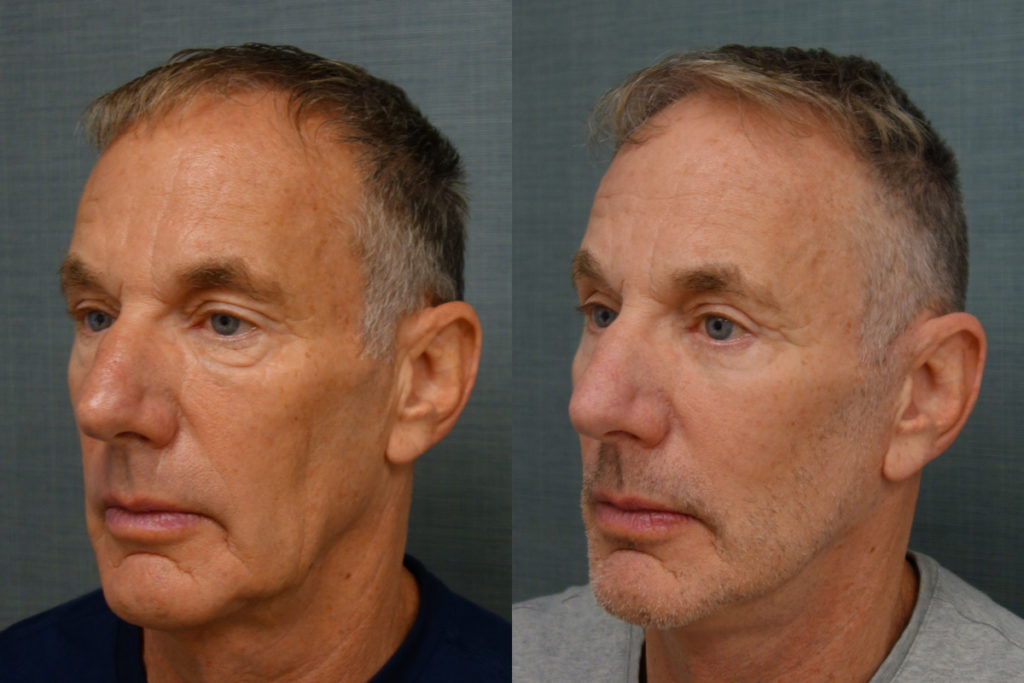 Bilateral Upper Eyelid Blepharoplasty, Bilateral Lower Eyelid Blepharoplasty, Bilateral Upper Eyelid Internal Ptosis Repair Patient 21-C Bilateral Upper Eyelid Blepharoplasty, Bilateral Lower Eyelid Blepharoplasty, Bilateral Upper Eyelid Internal Ptosis Repair Patient 21-C