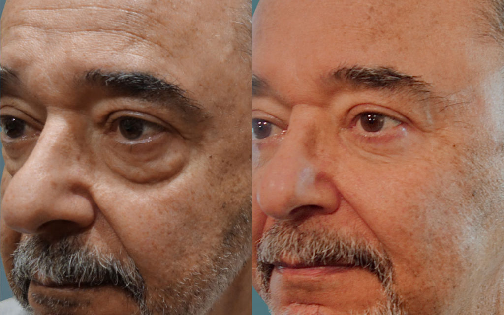 Bilateral Upper and Lower Eyelid Blepharoplasty Patient 49-B 