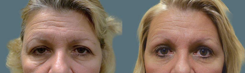 Upper Eyelid Blepharoplasty, Bilateral Internal Eyelid Ptosis Repair and Endoscopic Brow Lift Patient 20-A 