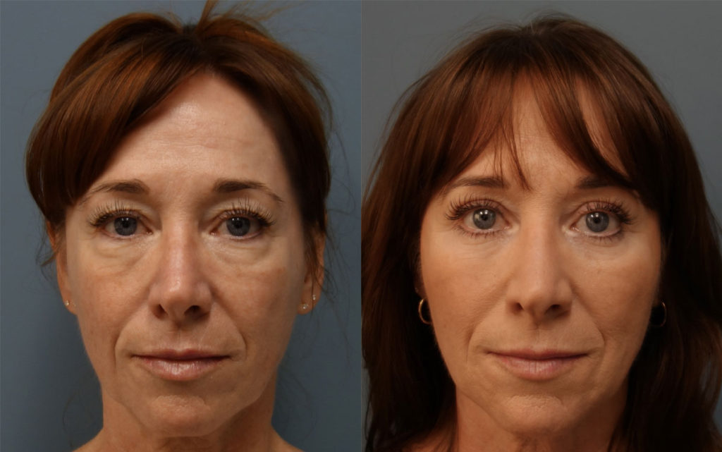 Bilateral Upper and Lower Eyelid Blepharoplasty, Eyelid Laser Resurfacing and  Facial Fat Grafting Patient 09-A 