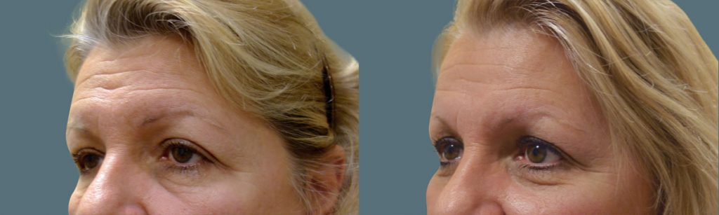Upper Eyelid Blepharoplasty, Bilateral Internal Eyelid Ptosis Repair and Endoscopic Brow Lift Patient 20-B 