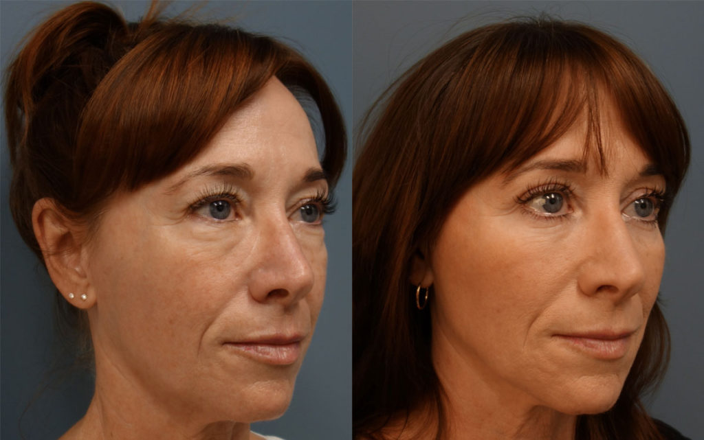 Bilateral Upper and Lower Eyelid Blepharoplasty, Eyelid Laser Resurfacing and  Facial Fat Grafting Patient 50-B 