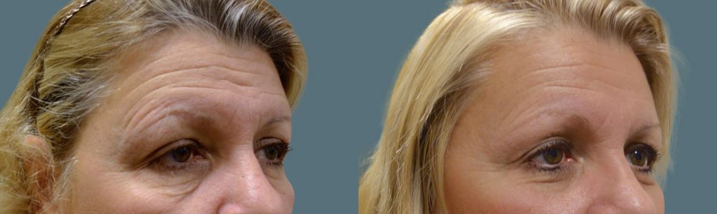 Upper Eyelid Blepharoplasty, Bilateral Internal Eyelid Ptosis Repair and Endoscopic Brow Lift Patient 20-C 