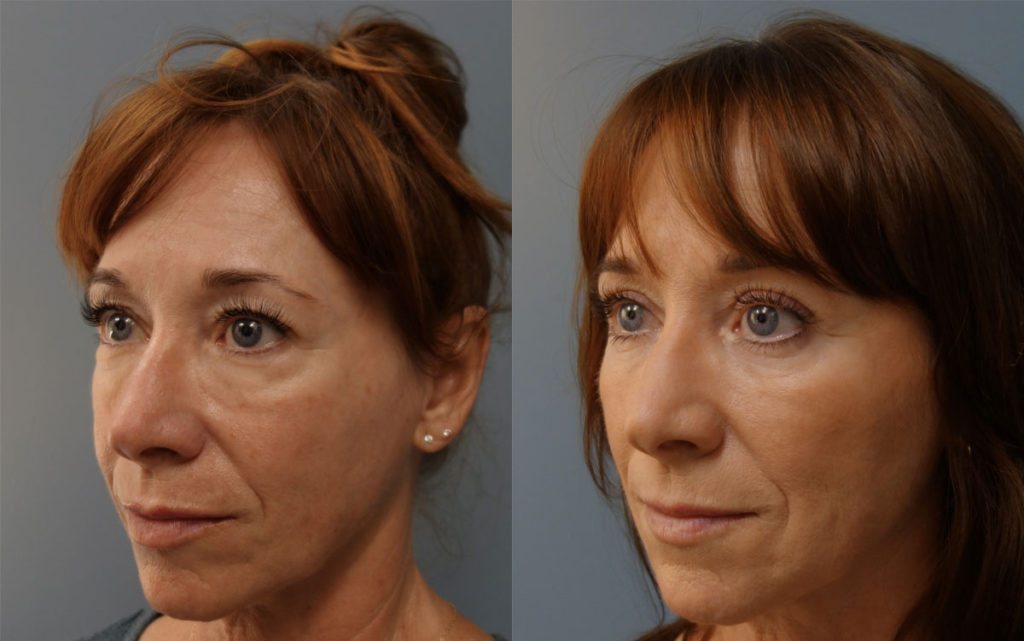 Bilateral Upper and Lower Eyelid Blepharoplasty, Eyelid Laser Resurfacing and  Facial Fat Grafting Patient 09-C 