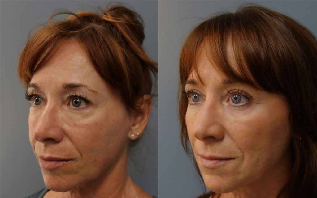 Bilateral Upper and Lower Eyelid Blepharoplasty, Eyelid Laser Resurfacing and  Facial Fat Grafting Patient 50-C 