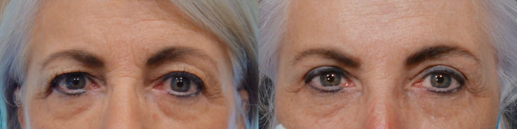 Upper Eyelid Blepharoplasty and Mini Temporal Brow Lift Patient 17 