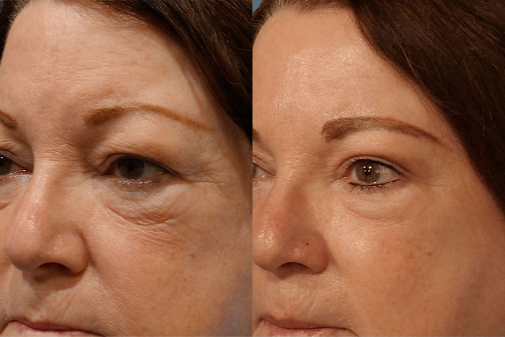 Bilateral Upper Eyelid Blepharoplasty and Bilateral Internal Ptosis Repair Patient 15-A 