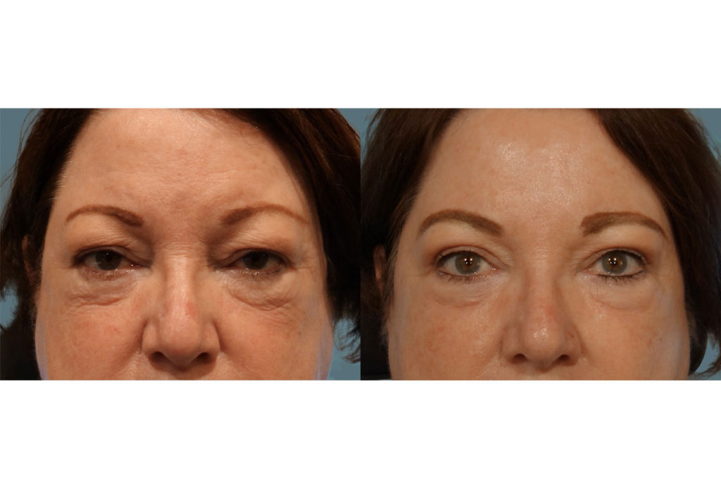 Bilateral Upper Eyelid Blepharoplasty and Bilateral Internal Ptosis Repair Patient 15-B 