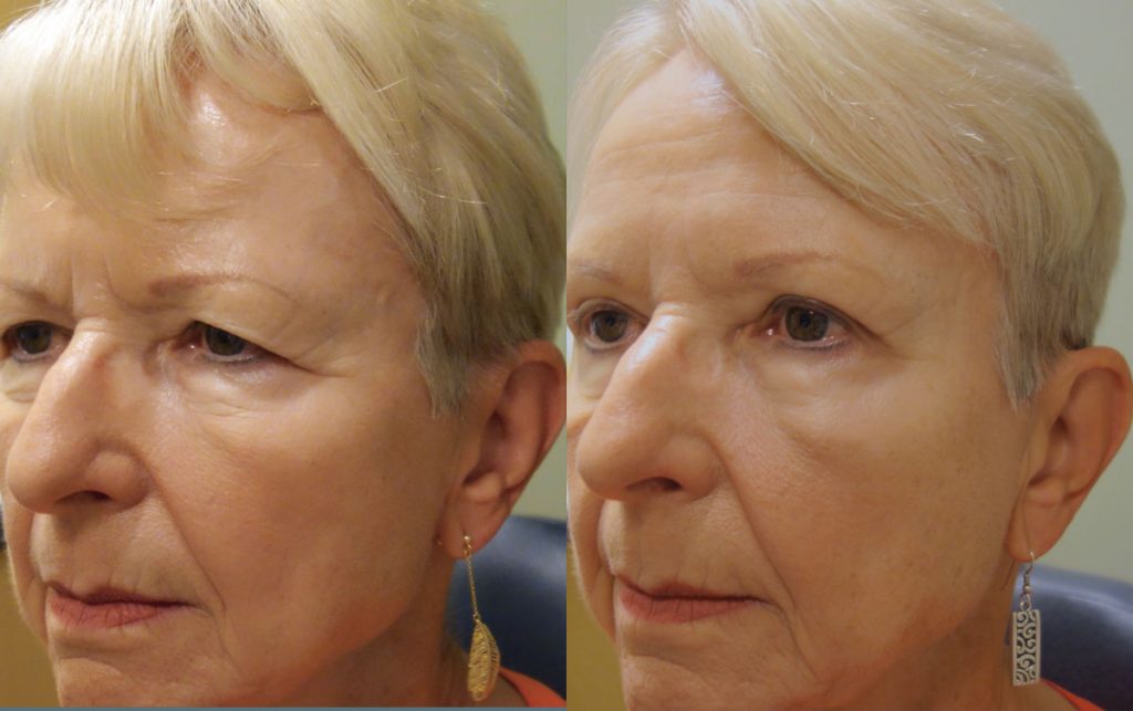 Upper Eyelid Blepharoplasty and Lateral Brow Patient 07-A 