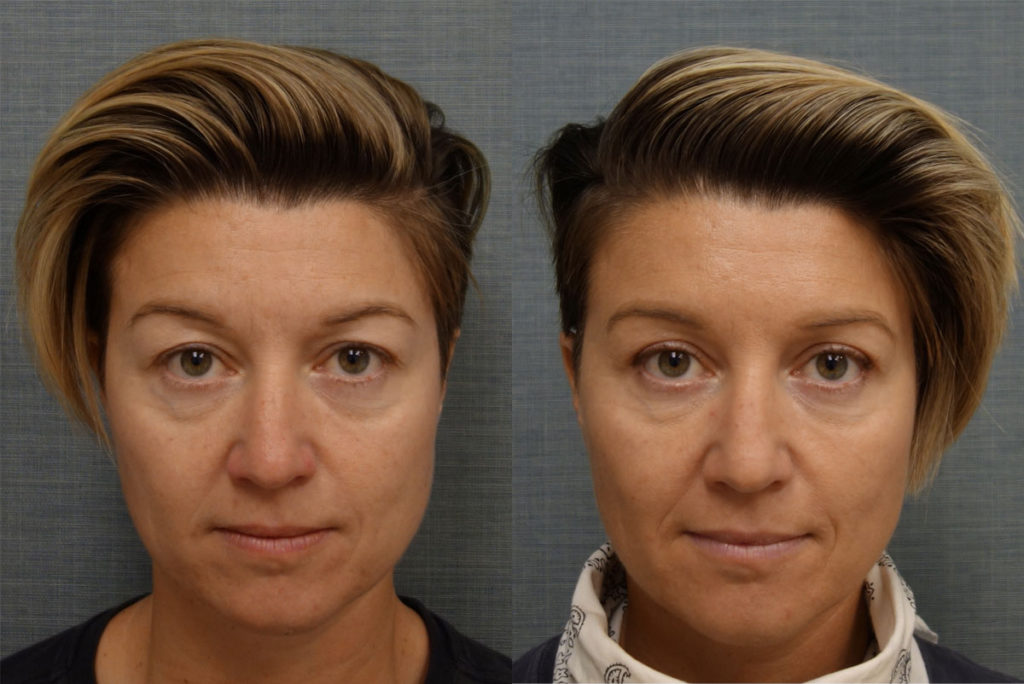 Bilateral Upper Eyelid Blepharoplasty Patient 17 