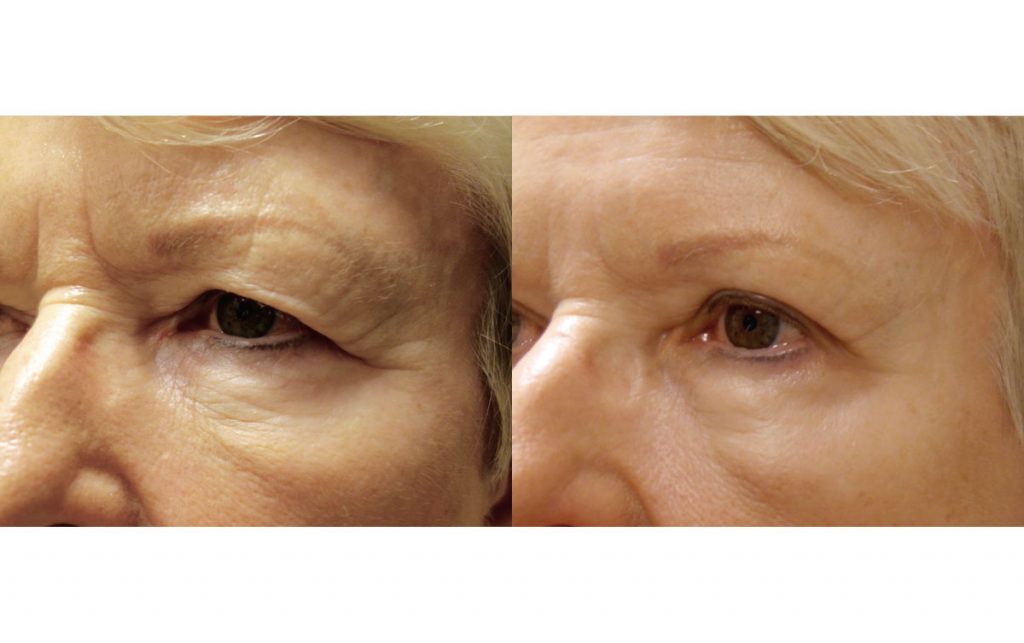 Upper Eyelid Blepharoplasty and Lateral Brow Patient 23-B 