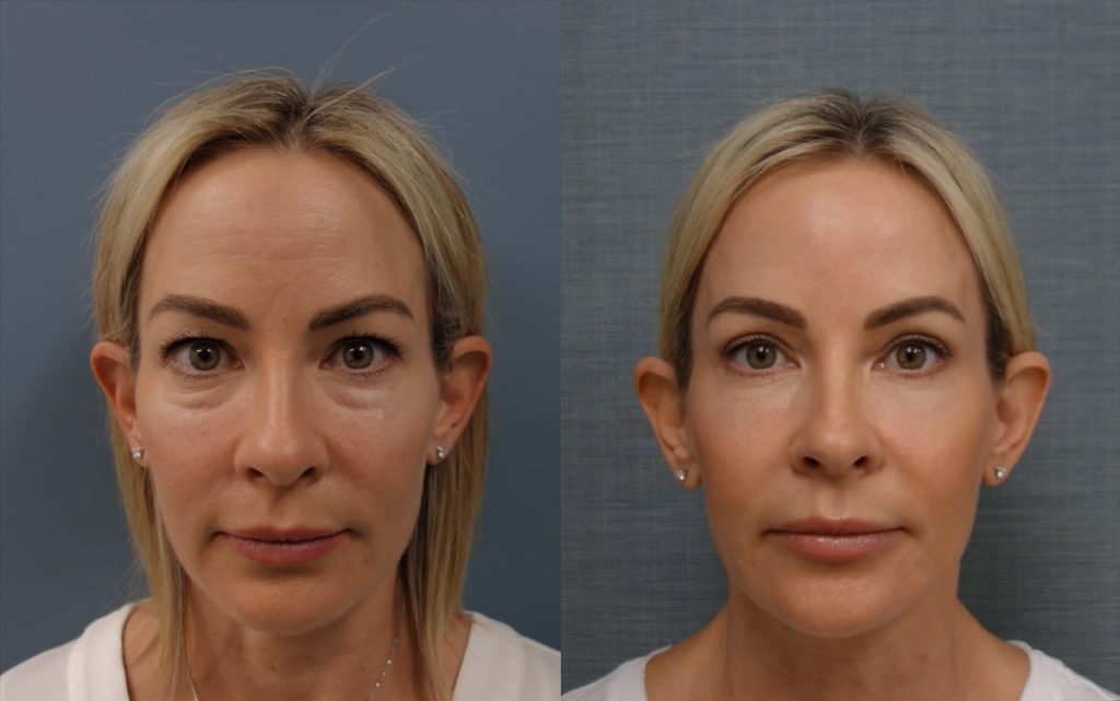 Upper and Lower Eyelid Blepharoplasty and Eyelid Laser Resurfacing Patient 01-A 
