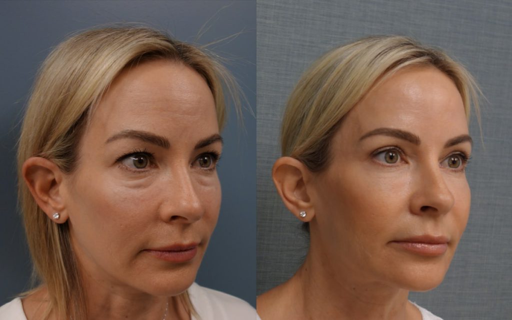 Upper and Lower Eyelid Blepharoplasty and Eyelid Laser Resurfacing Patient 04-B 