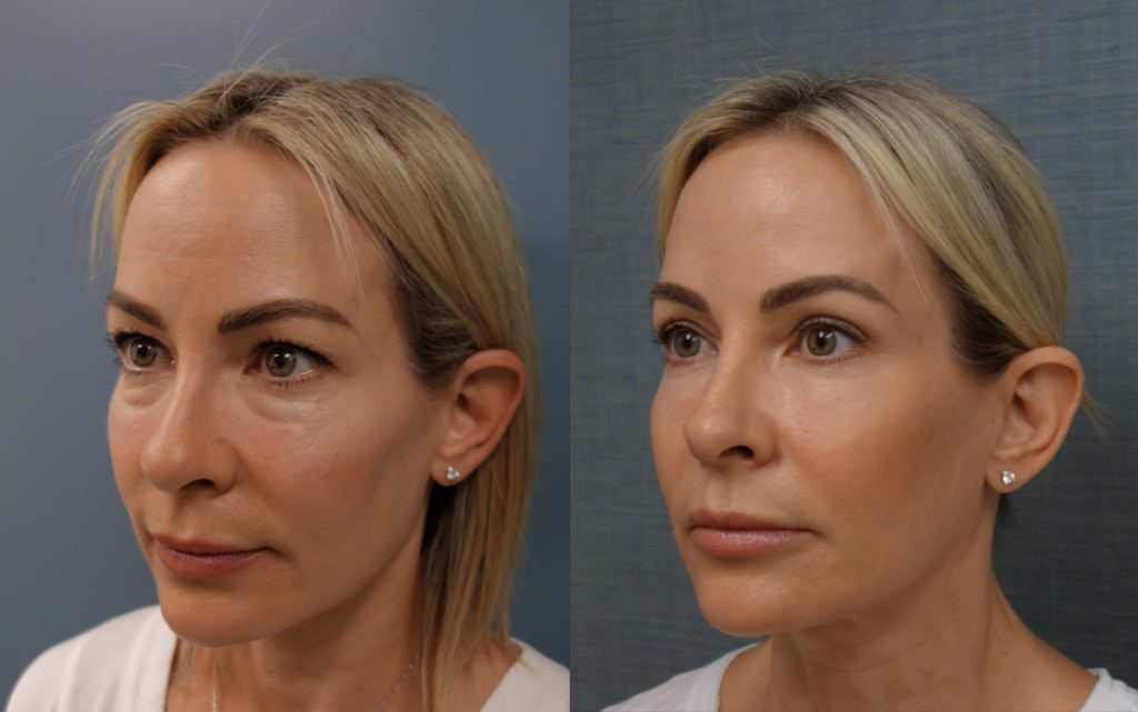 Upper and Lower Eyelid Blepharoplasty and Eyelid Laser Resurfacing Patient 04-C 