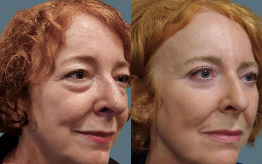 Bilateral Upper and Lower Blepharoplasty, Chemical Peel Eyelids Patient 09-B 