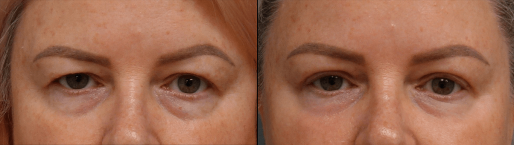 Upper Eyelid Blepahroplasty, Chemical Peel Lower Eyelids Patient 49-A 