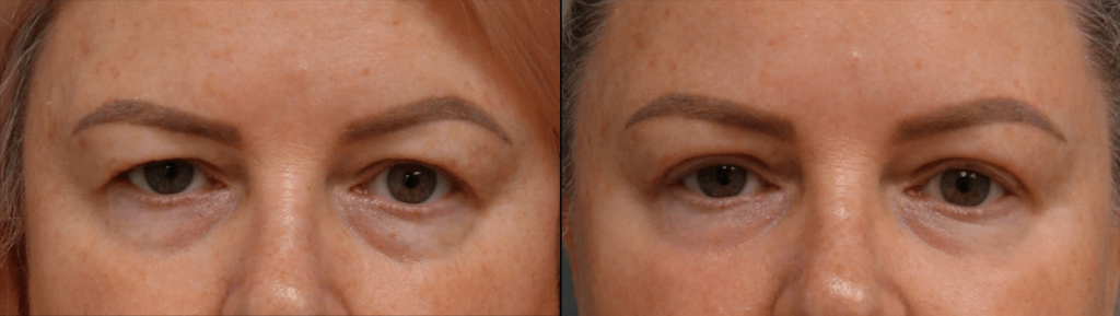 Upper Eyelid Blepahroplasty, Chemical Peel Lower Eyelids Patient 50-A 