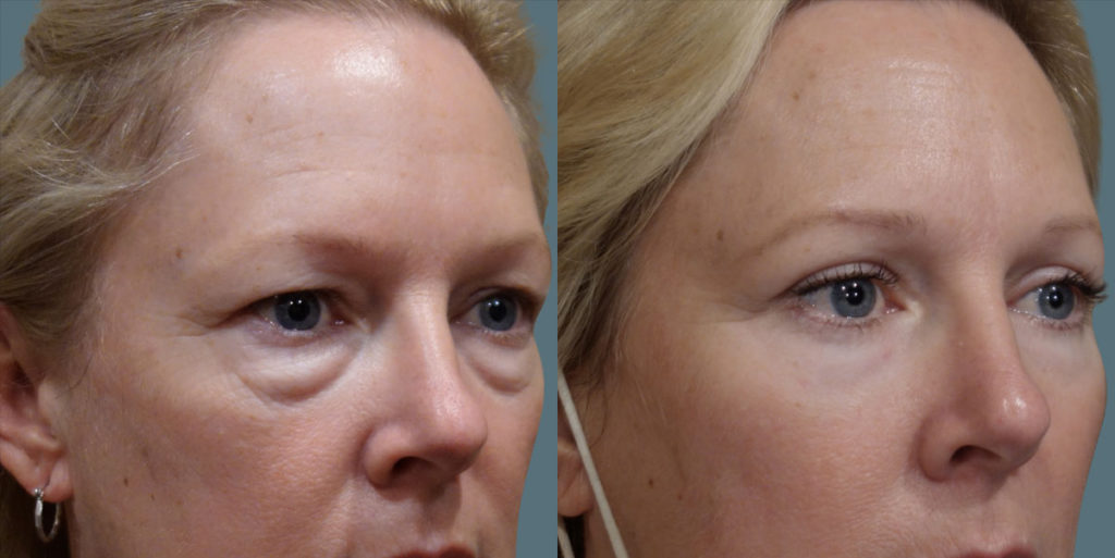 Upper and Lower Eyelid Blepharoplasty Patient 02-B 