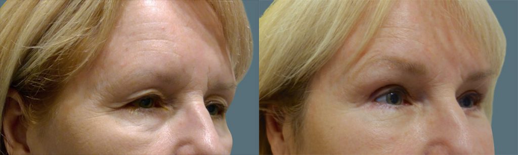 Upper and Lower Eyelid Blepharoplasty and Endoscopic Brow Lift Patient 18-B 