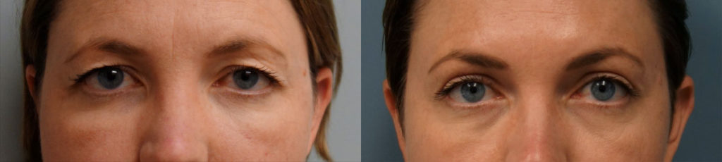 Bilateral Upper Blepharoplasty, Mini Brow Lift, Left Upper Eyelid Internal Ptosis Repair Patient 04-C 