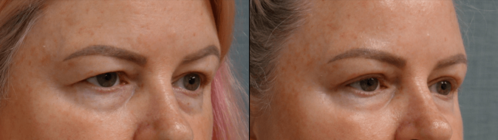 Upper Eyelid Blepahroplasty, Chemical Peel Lower Eyelids Patient 50-B 
