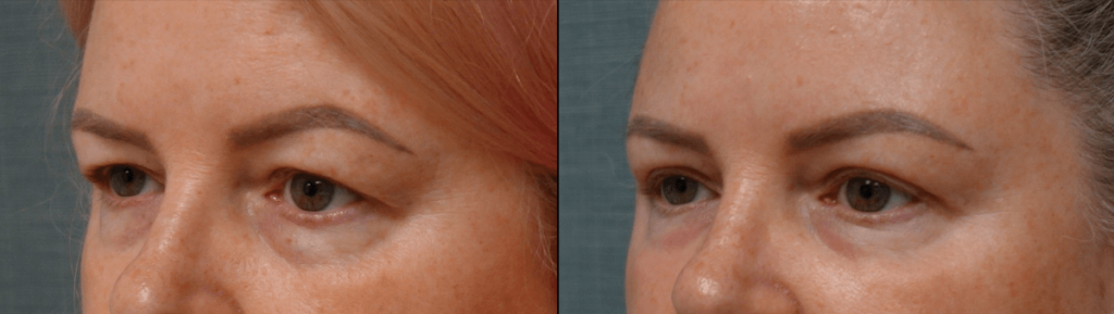 Upper Eyelid Blepahroplasty, Chemical Peel Lower Eyelids Patient 50-C 