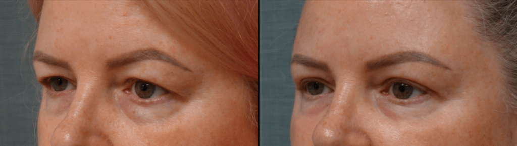 Upper Eyelid Blepahroplasty, Chemical Peel Lower Eyelids Patient 49-C 