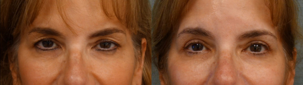 Bilateral Upper Eyelid Blepharoplasty, Bilateral Upper Eyelid Internal Ptosis Repair Patient 22-A Bilateral Upper Eyelid Blepharoplasty, Bilateral Upper Eyelid Internal Ptosis Repair Patient 22-A