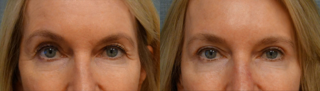 Bilateral Upper Eyelid Blepharoplasty Patient 62-A 