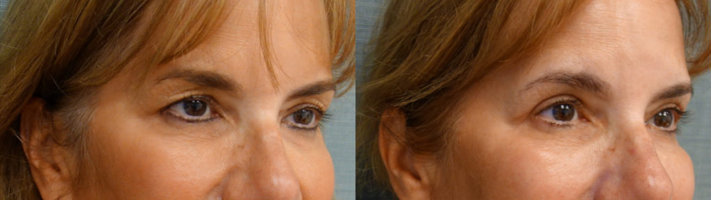 Bilateral Upper Eyelid Blepharoplasty, Bilateral Upper Eyelid Internal Ptosis Repair Patient 22-B Bilateral Upper Eyelid Blepharoplasty, Bilateral Upper Eyelid Internal Ptosis Repair Patient 22-B