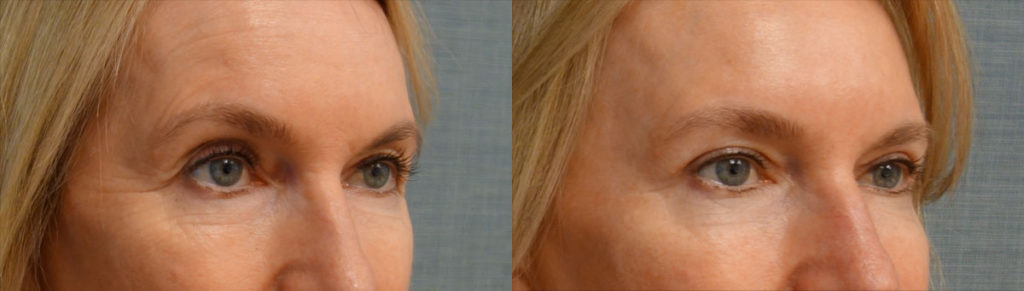 Bilateral Upper Eyelid Blepharoplasty Patient 62-B 