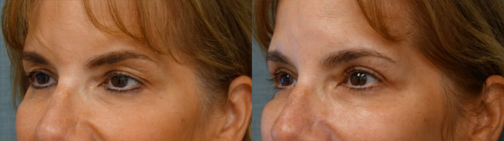 Bilateral Upper Eyelid Blepharoplasty, Bilateral Upper Eyelid Internal Ptosis Repair Patient 22-C Bilateral Upper Eyelid Blepharoplasty, Bilateral Upper Eyelid Internal Ptosis Repair Patient 22-C