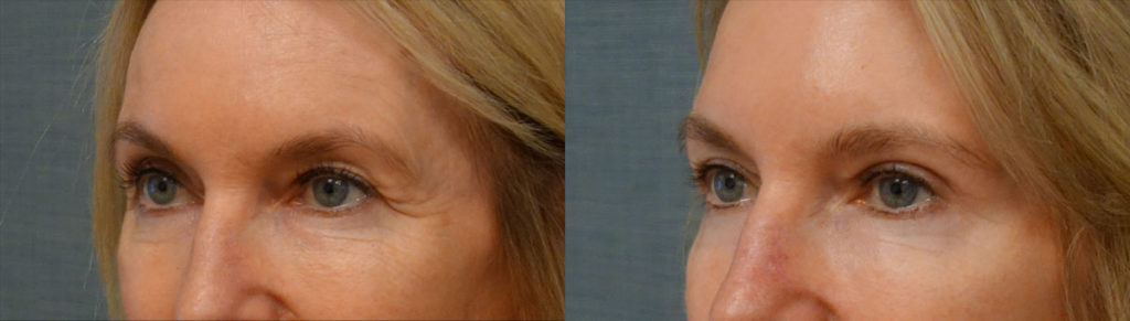 Bilateral Upper Eyelid Blepharoplasty Patient 62-C 