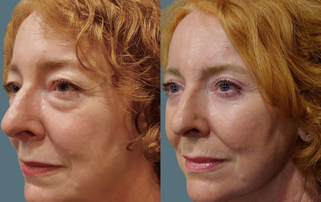 Bilateral Upper and Lower Blepharoplasty, Chemical Peel Eyelids Patient 09-C 