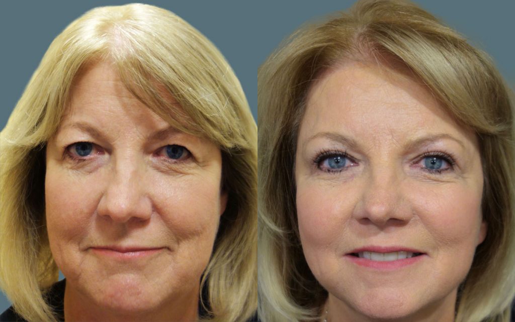 Upper Eyelid Blepharoplasty and Mini Temporal Brow Lift Patient 18-A 