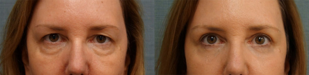 Bilateral Upper and Lower Eyelid Blepharoplasty, Chemical Peel Eyelids Patient 17-A 