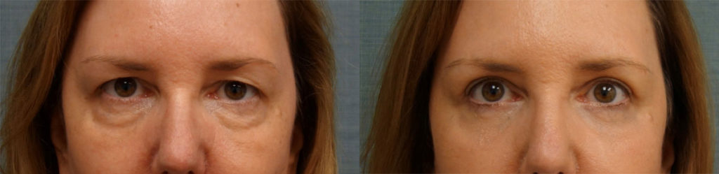 Bilateral Upper and Lower Eyelid Blepharoplasty, Chemical Peel Eyelids Patient 18-A 