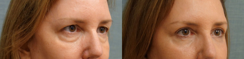 Bilateral Upper and Lower Eyelid Blepharoplasty, Chemical Peel Eyelids Patient 17-B 