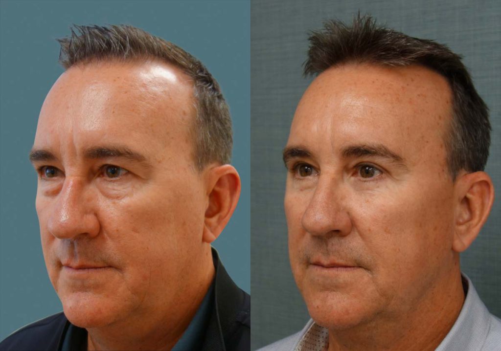 Upper and Lower Blepharoplasty, Eyelid Laser Resurfacing Patient 02-C 