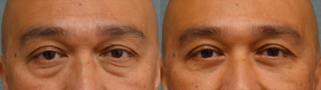 Lower Eyelid Blepharoplasty Patient 07-A 