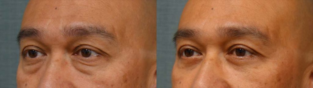 Lower Eyelid Blepharoplasty Patient 07-C 