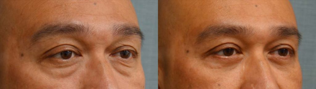 Lower Eyelid Blepharoplasty Patient 07-B 