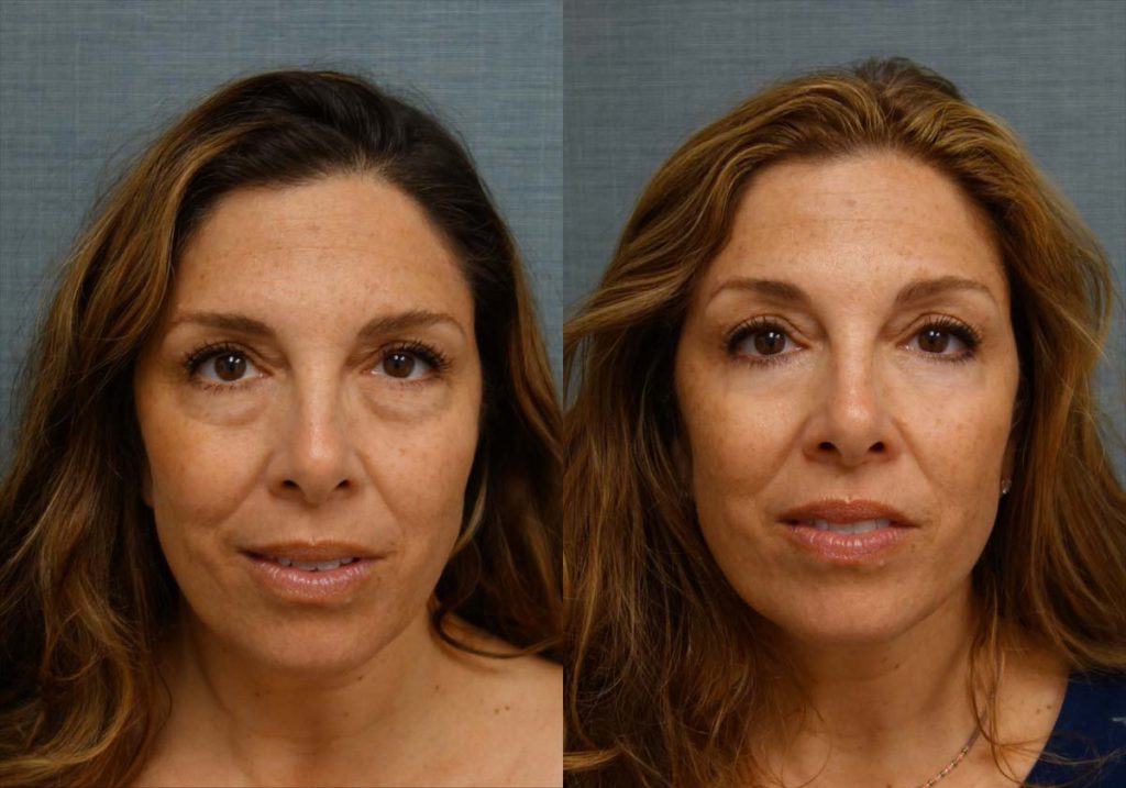 Lower Eyelid Blepharoplasty with Chemical Peel Patient 08-A 