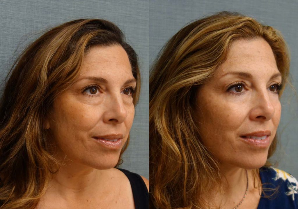 Lower Eyelid Blepharoplasty with Chemical Peel Patient 08-B 
