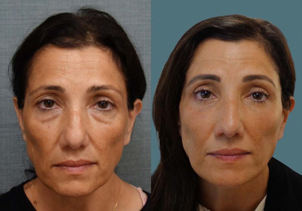 Upper and Lower Eyelid Blepharoplasty, Eyelid Laser Resurfacing and Morpheus Microneedling to Full Face and Lower Eyelids Patient 09 