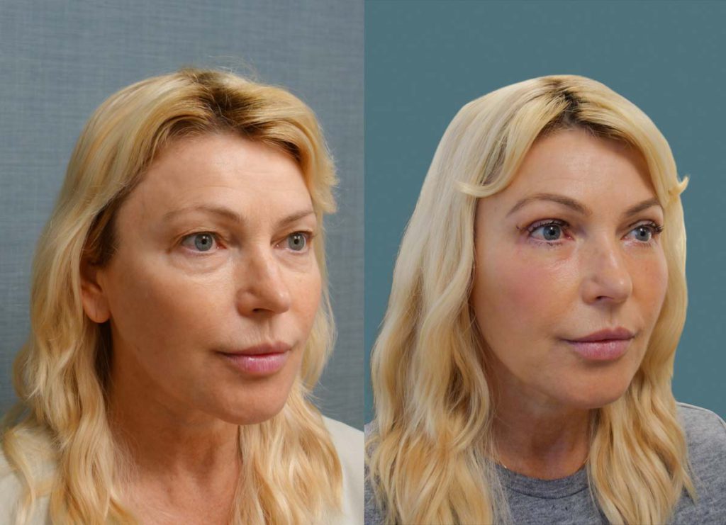 Upper and Lower Eyelid Blepharoplasty with Chemical Peel (1 Week Post Op) Patient 09-B 