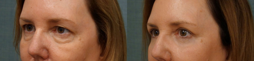 Bilateral Upper and Lower Eyelid Blepharoplasty, Chemical Peel Eyelids Patient 17-C 