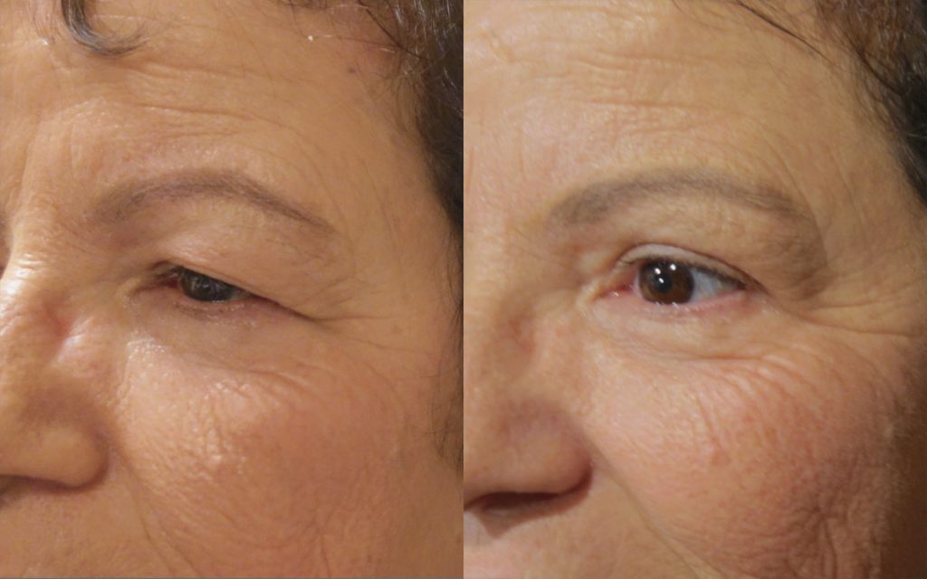 Upper Eyelid Blepharoplasty and Lateral Brow Lift Patient 18-B 