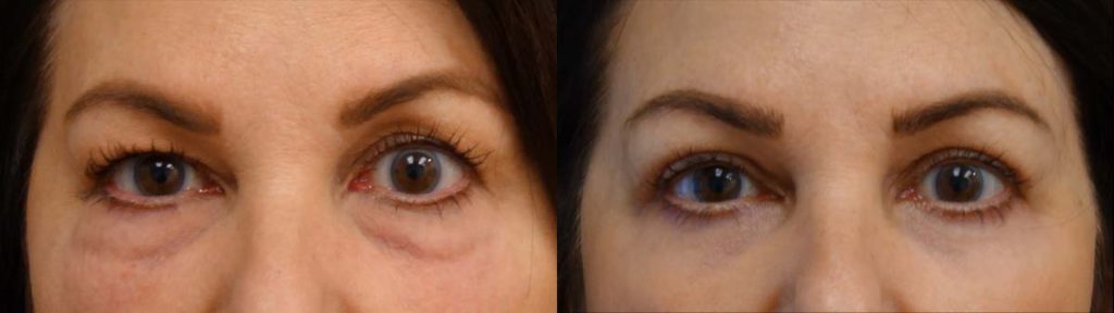 Upper and Lower Eyelids with Chemical Peel Patient 10-A 